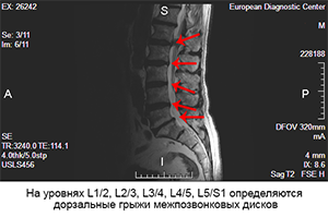 грыжи поясницы