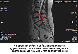 грыжи поясницы