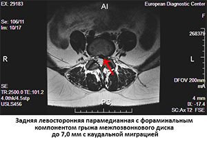 грыжа в аксиальной проекции мрт